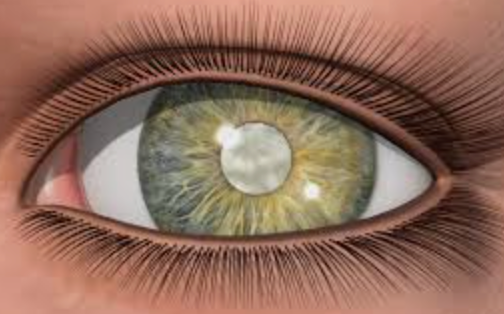 Cataract Surgery - What to Expect